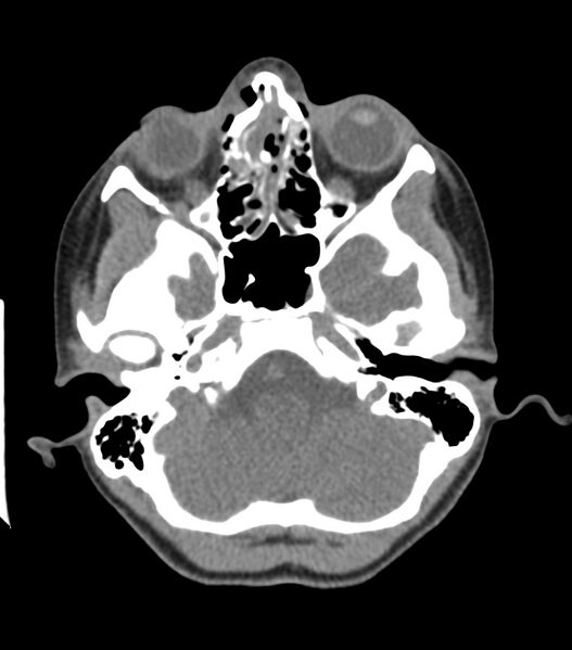 File:Nasoorbitoethmoid fracture (Radiopaedia 90044-107205 Axial non-contrast 149).jpg