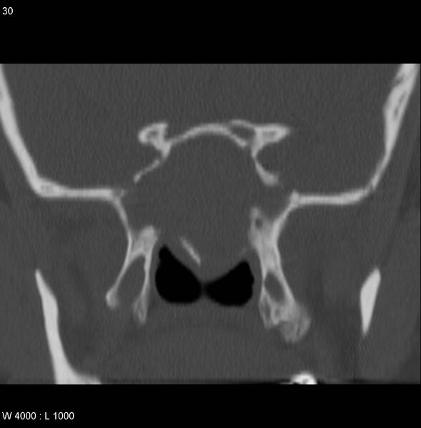 File:Nasopharyngeal carcinoma (recurrent) (Radiopaedia 5061-6903 Coronal bone window 8).jpg