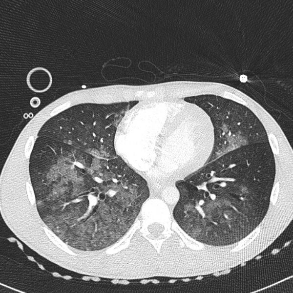 File:Near drowning (pulmonary edema) (Radiopaedia 24685-24958 lung window 47).jpg
