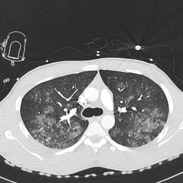 File:Near drowning (pulmonary edema) (Radiopaedia 24685-24958 lung window 9).jpg