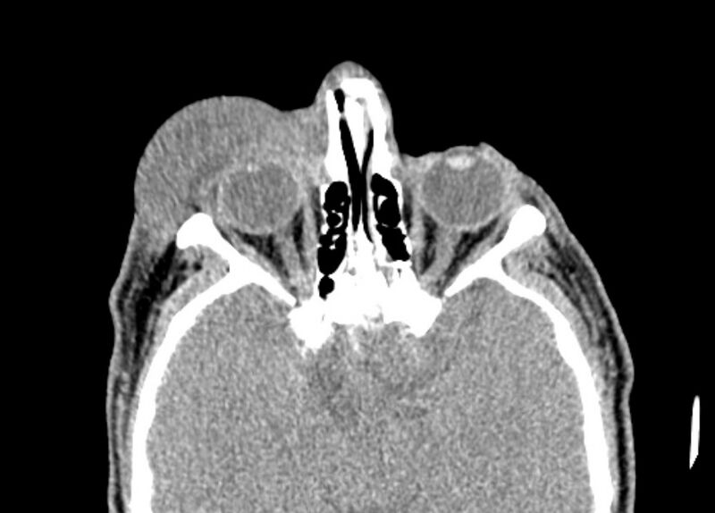 File:Necrobiotic xanthogranuloma- face (Radiopaedia 29549-30052 Axial C+ delayed 4).jpg