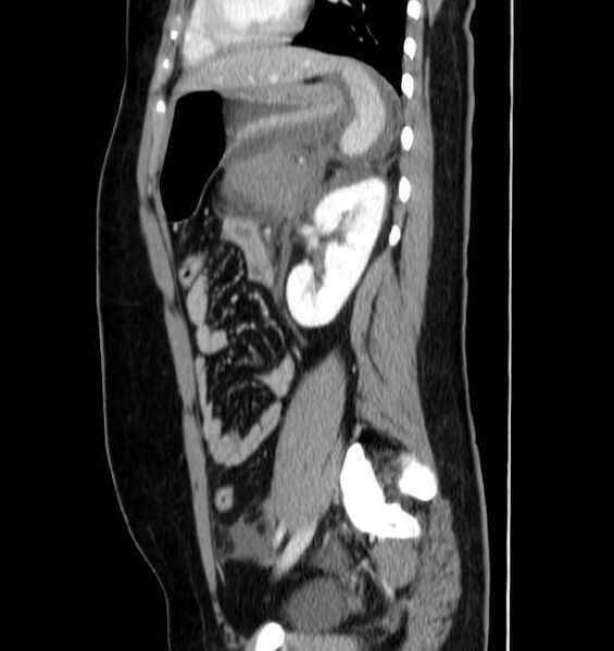File:Necrotizing pancreatitis (Radiopaedia 23001-23031 C 55).jpg