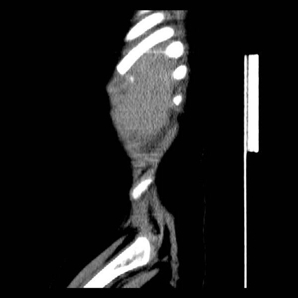 File:Neuroblastoma with skull metastases (Radiopaedia 30326-30960 B 2).jpg