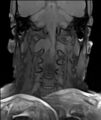 Neurofibromatosis type 1 (Radiopaedia 80355-93740 Coronal T1 6).jpg