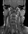 Neurofibromatosis type 1 (Radiopaedia 80355-93740 I 4).jpg