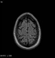 Neurosarcoidosis (Radiopaedia 10930-11351 Axial FLAIR 18).jpg