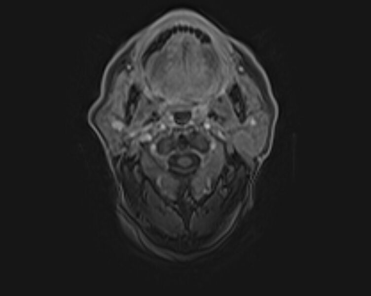 File:Non-Hodgkin lymphoma - parotid gland (Radiopaedia 71531-81890 E 37).jpg