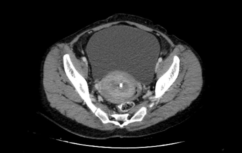 File:Non-puerperal uterine inversion (Radiopaedia 78343-91094 A 19).jpg
