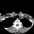 Normal CT of the neck (Radiopaedia 14575-14500 Axial C+ 61).jpg