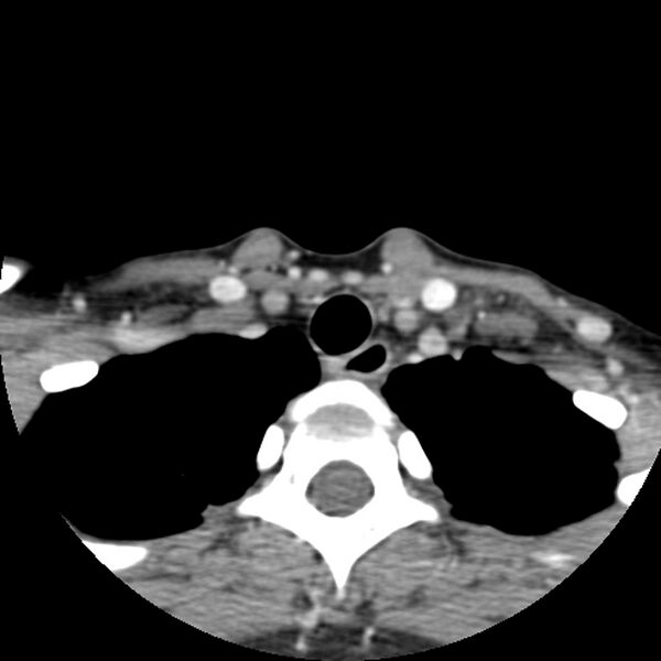 File:Normal CT of the neck (Radiopaedia 14575-14500 Axial C+ 61).jpg