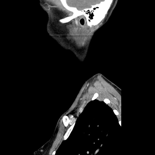 File:Normal CT of the neck (Radiopaedia 14575-14500 Sagittal C+ 46).jpg