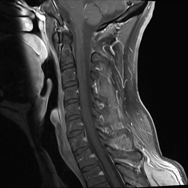 File:Normal MRI cervical spine (infection protocol) (Radiopaedia 53916-60039 I 7).png