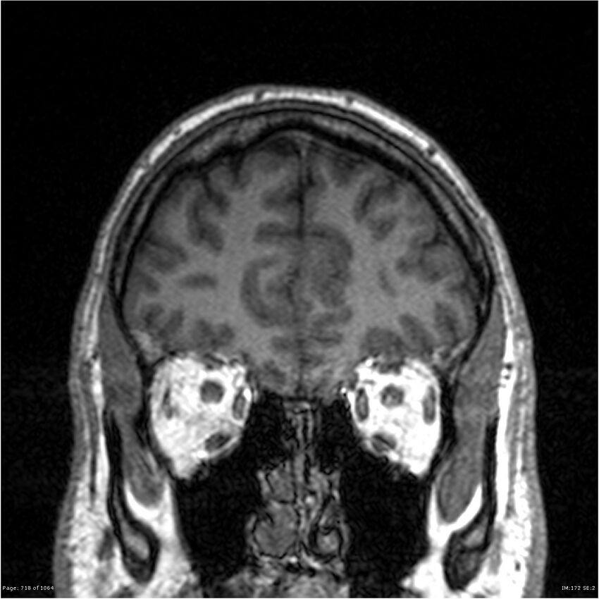 Normal brain MRI (non-focal epilepsy protocol) (Radiopaedia 38571-40700 Coronal T1 85).jpg