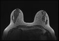 Normal breast MRI - dense breasts (Radiopaedia 80454-93850 Axial T1 79).jpg