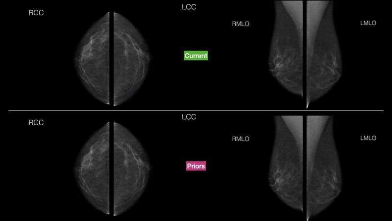 File:Normal breast mammography (tomosynthesis) and ultrasound (Radiopaedia 65325-102031 Current v priors 1).jpeg