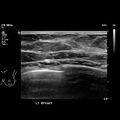 Normal breast mammography (tomosynthesis) and ultrasound (Radiopaedia 65325-74354 Left breast 8).jpeg