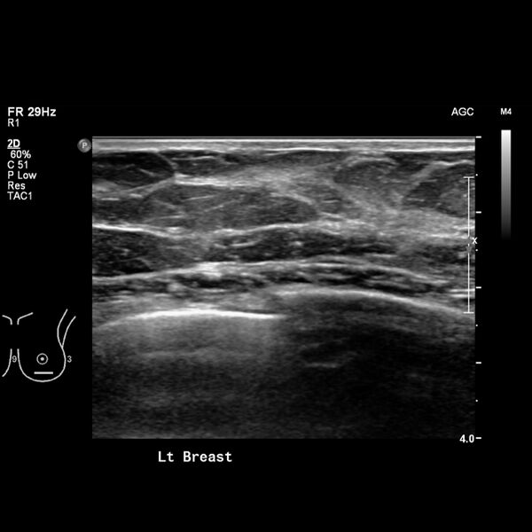 File:Normal breast mammography (tomosynthesis) and ultrasound (Radiopaedia 65325-74354 Left breast 8).jpeg