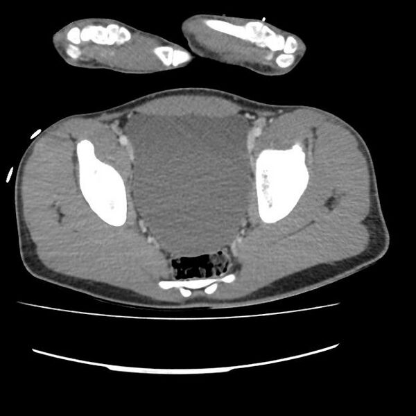 File:Normal dual-phase trauma CT chest,abdomen and pelvis (Radiopaedia 48092-52899 A 104).jpg