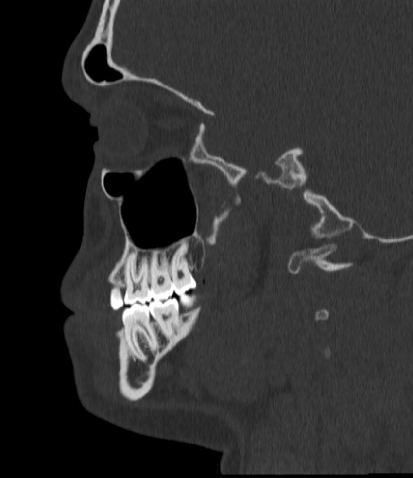 Normal facial bone CT (Radiopaedia 88742-105476 Sagittal bone window 62).jpg