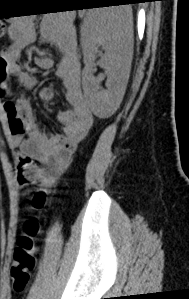 File:Normal lumbar spine CT (Radiopaedia 46533-50986 C 2).png