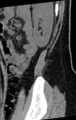 Normal lumbar spine CT (Radiopaedia 46533-50986 C 2).png