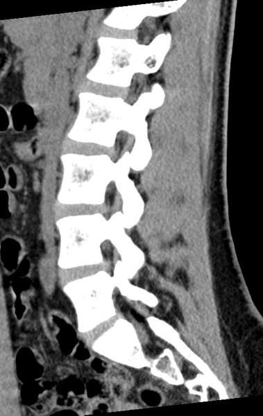 File:Normal lumbar spine CT (Radiopaedia 46533-50986 C 61).png