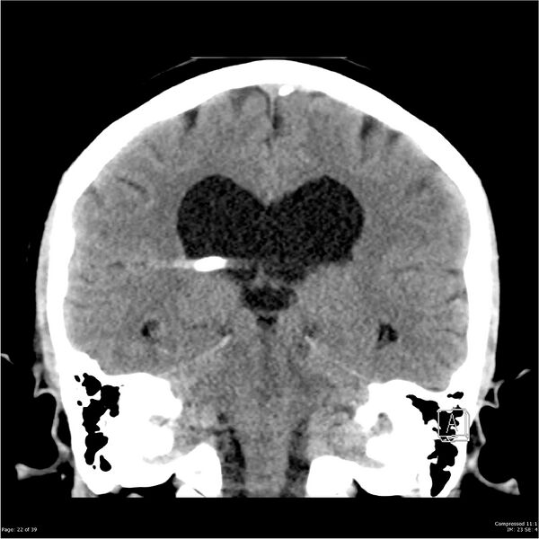 File:Normal pressure hydrocephalus (Radiopaedia 24415-24736 Coronal non-contrast 18).jpg