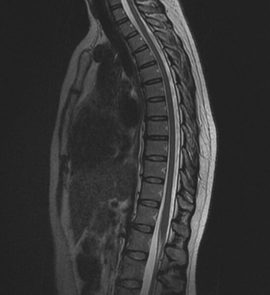 File:Normal thoracic spine MRI (Radiopaedia 41033-43781 Sagittal T2 7).jpg