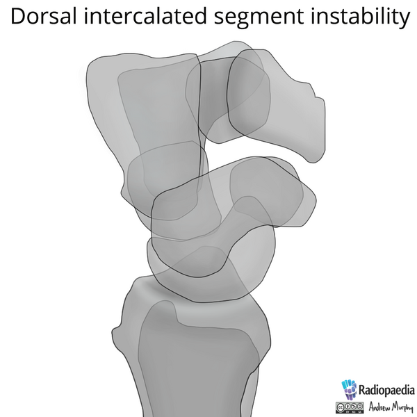File:Normal wrist alignment, dorsal and volar intercalated segmental instability (illustration) (Radiopaedia 80949-94486 A 5).png