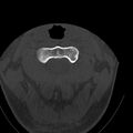 Occipital condyle fracture (Radiopaedia 31755-32691 Axial bone window 19).jpg