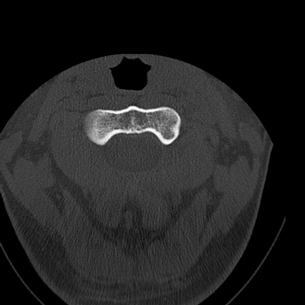 File:Occipital condyle fracture (Radiopaedia 31755-32691 Axial bone window 19).jpg