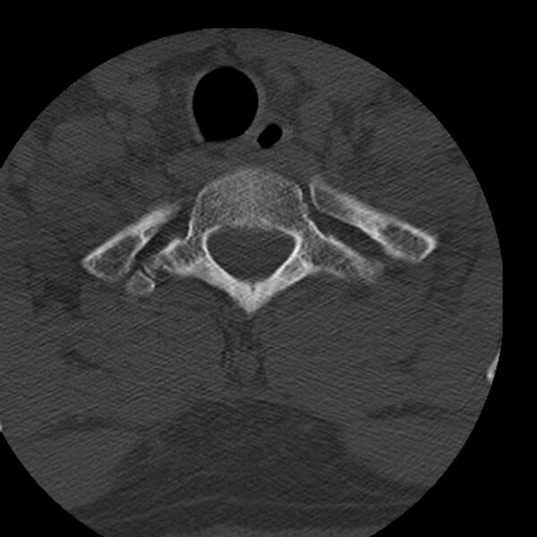 File:Occipital condyle fracture (Radiopaedia 31755-32691 Axial bone window 74).jpg