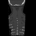 Occipital condyle fracture (Radiopaedia 31755-32691 Coronal bone window 35).jpg