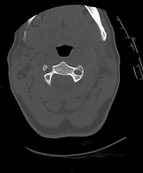 File:Occipital condyle fracture (Radiopaedia 61165-69056 D 12).jpg