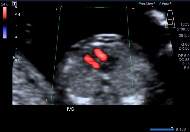 File:1st trimester nuchal-morphology ultrasound (Radiopaedia 44706-48477 General anatomy and NT 17).jpg