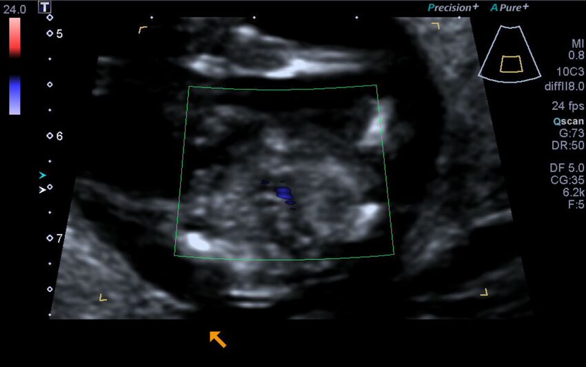1st trimester nuchal-morphology ultrasound (Radiopaedia 44706-48477 Heart views cine with colour 199).jpg