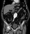 Abdominal aortic aneurysm (Radiopaedia 25855-26001 Coronal C+ arterial phase 24).jpg