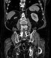 Abdominal aortic aneurysm (Radiopaedia 25855-26001 Coronal C+ arterial phase 57).jpg