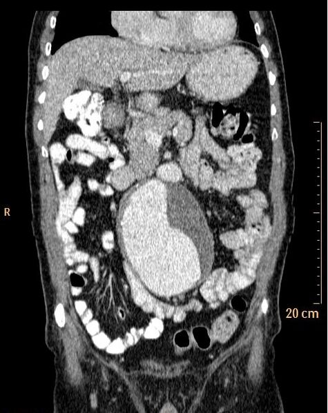 File:Abdominal aortic aneurysm (Radiopaedia 25985-26121 Coronal C+ arterial phase 10).jpg