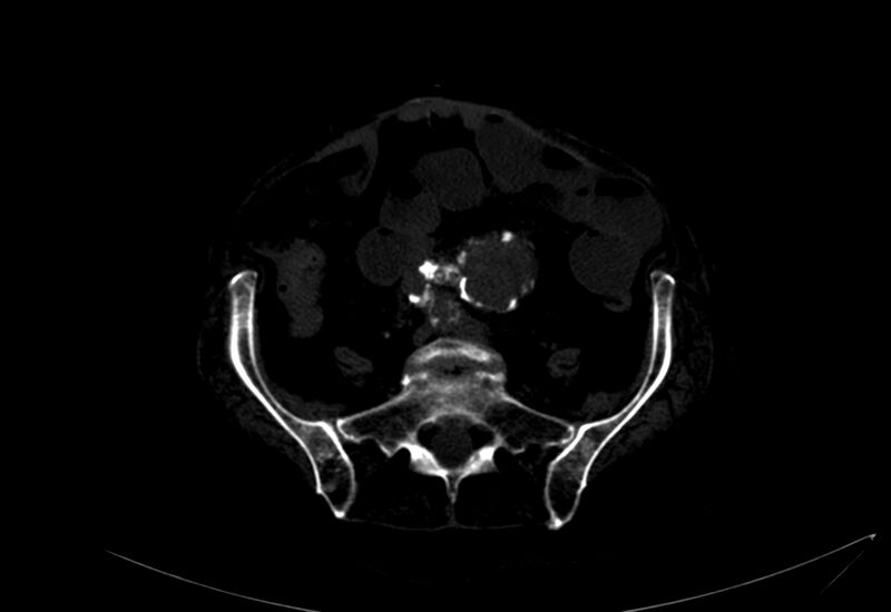 File:Abdominal aortic aneurysm - impending rupture (Radiopaedia 19233-19246 B 38).jpg