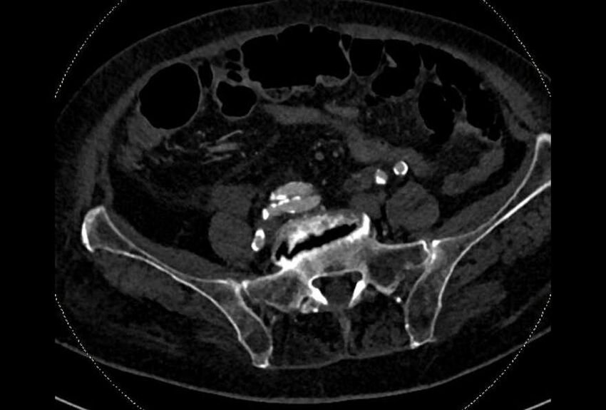 Abdominal aortic aneurysm with thrombus fissuration (Radiopaedia 73192-83919 Axial C+ arterial phase 157).jpg