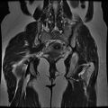 Abdominal wall endometriosis (Radiopaedia 83702-98847 Coronal T2 13).jpg