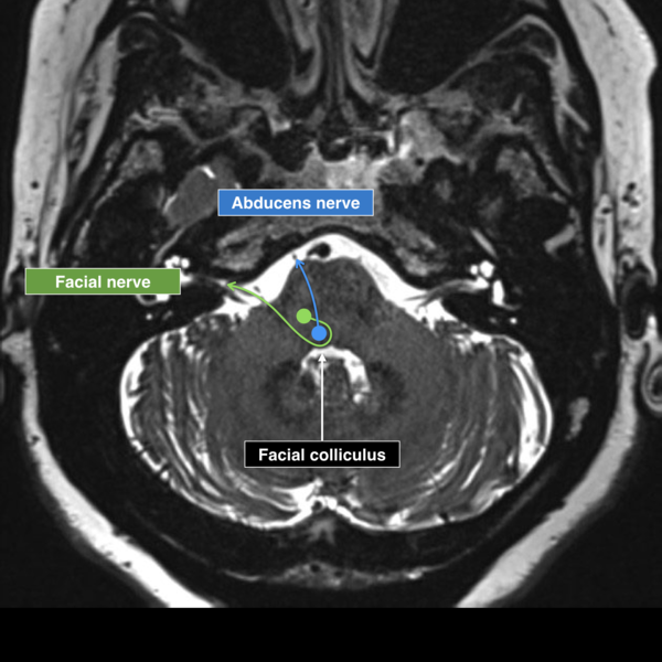 File:Abducens and facial cranial nerves and nuclei (Radiopaedia 50811).png