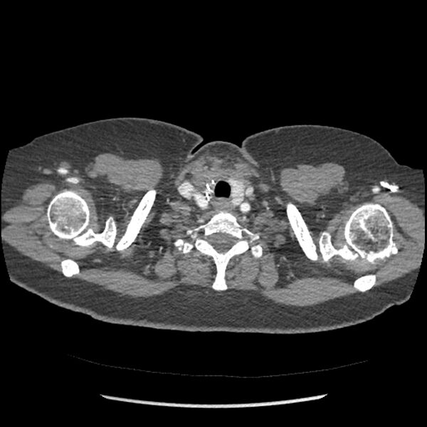 File:Aberrant right subclavian and left vertebral arteries (Radiopaedia 43467-46847 Axial C+ portal venous phase 3).jpg