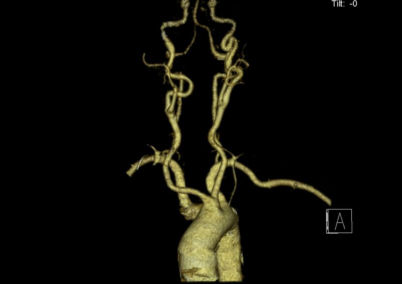 File:Aberrant right subclavian artery (Radiopaedia 19283-19294 3D reconstruction C+ arterial phase 6).jpg