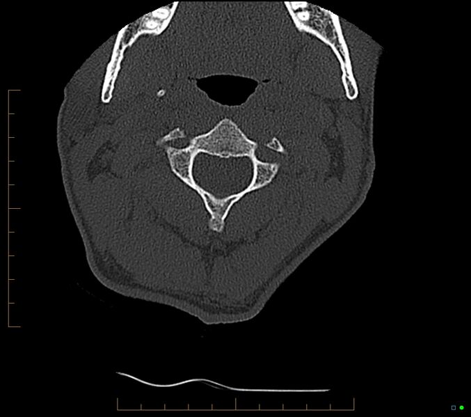 File:Accessory articulation of cervical transverse processes (Radiopaedia 82715-96933 Axial non-contrast 36).jpg