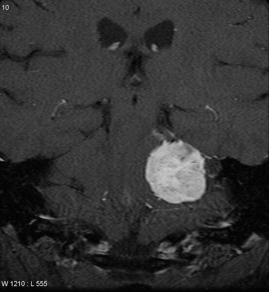 File:Acoustic schwannoma (large with cystic change) (Radiopaedia 5369-7130 Coronal T1 C+ fat sat 7).jpg