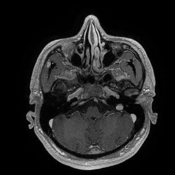 File:Acoustic schwannoma - intracanalicular (Radiopaedia 37247-39024 Axial T1 C+ 59).jpg