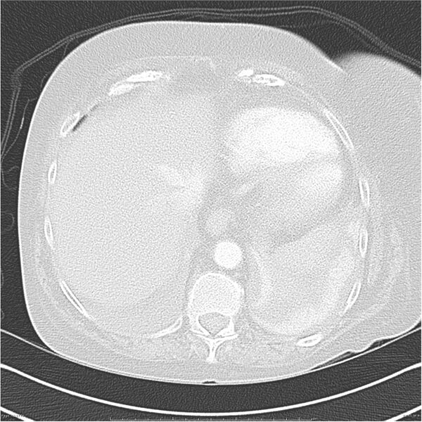 File:Acute-on-chronic pulmonary emboli (Radiopaedia 27925-28169 lung window 41).jpg
