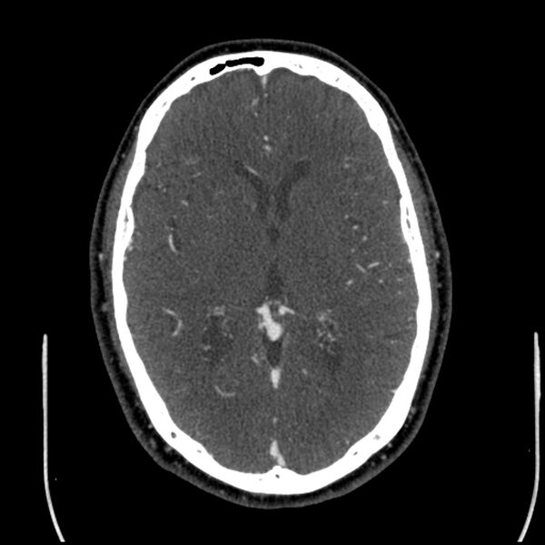 File:Acute A3 occlusion with ACA ischemic penumbra (CT perfusion) (Radiopaedia 72036-82527 Axial C+ arterial phase thins 68).jpg